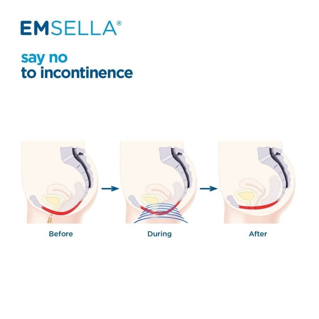 Emsella urinary incontinence treatments are now offered in Lawrenceville GA