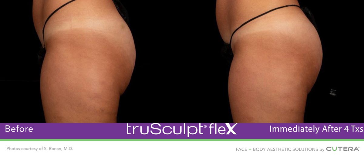 Lawrenceville Family Practice, PC, offers family medicine and med spa services like truSculpt flex in Lawrenceville, GA.